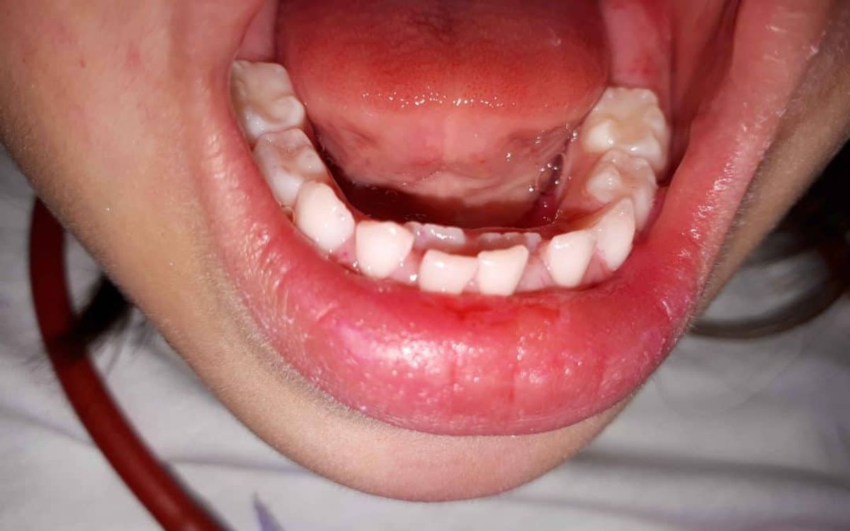 Φωτογραφία παιδικού στόματος με 2 σειρές από δόντια